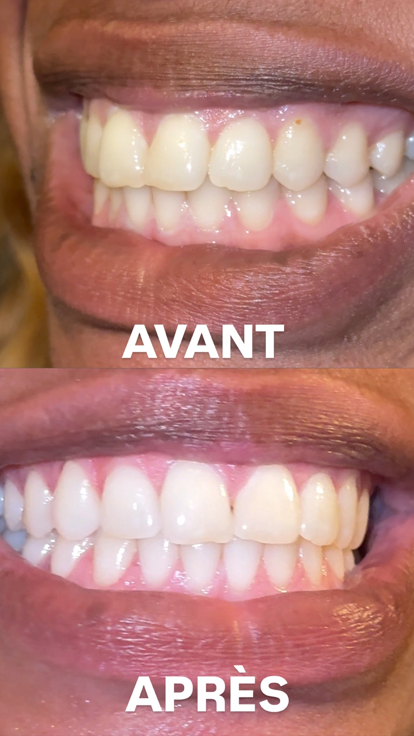 PRÉCOMMANDE PALMCARE WHITENING+